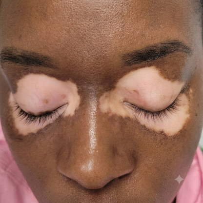 VITILIGO CARE SPRAY